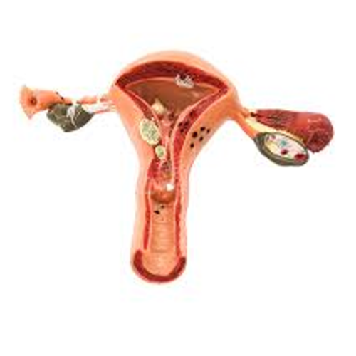 Mô hình giải phẫu bệnh lý hệ sinh dục nữ